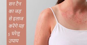 Read more about the article सन टैनिंग हटाने के 5 घरेलू उपाय – How to remove tanning in hindi